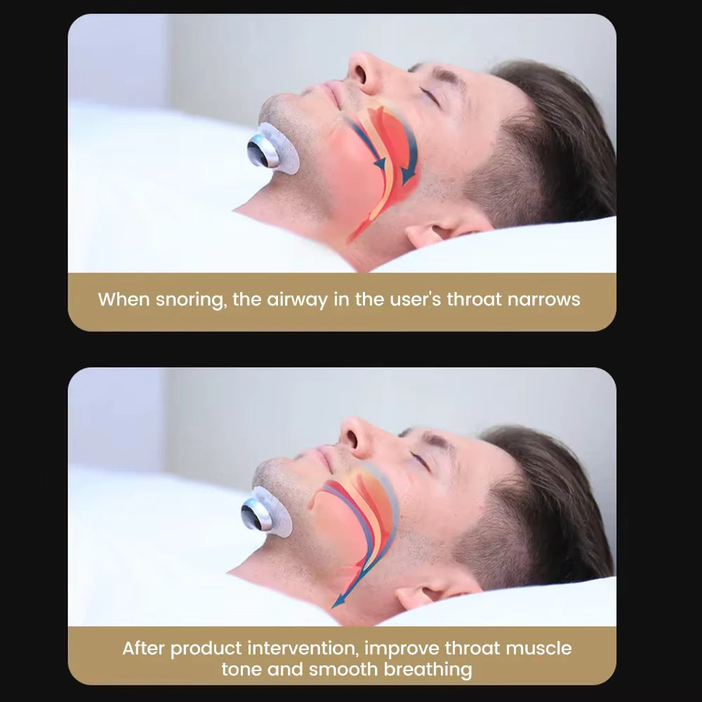 Portable Anti-Snoring Device - Sleep Better with Our Mini Electric Snoring Corrector