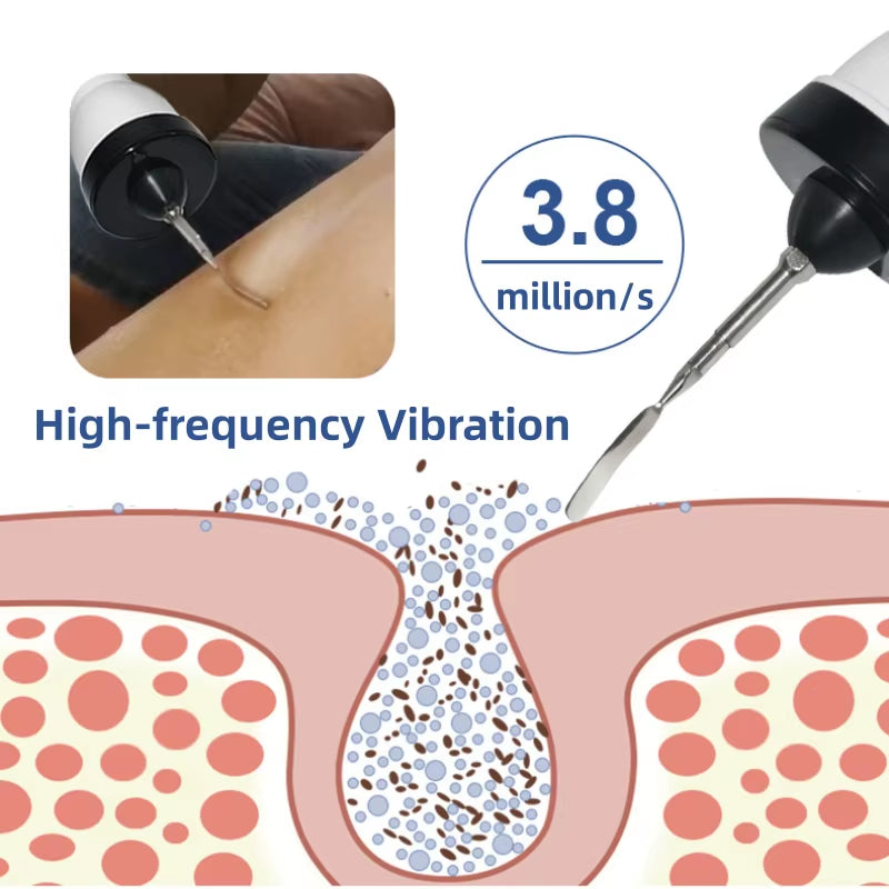 Ultrasonic Blackhead Remover & Facial Cleansing Vibrator - Pore Minimizing Skincare Device